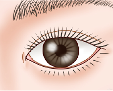 施術前：目頭の目立つ傷跡